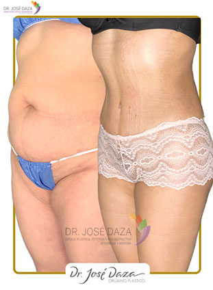 Abdominoplastia