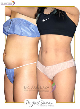 Lipoabdominoplastia