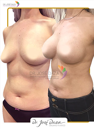 Mamoplastia