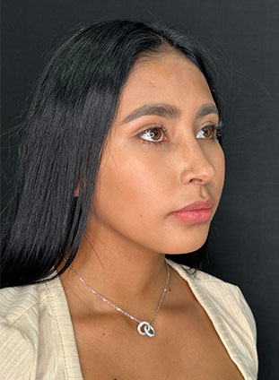 Rinoplastia