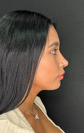 Perfiloplastia