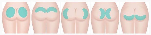implantes gluteo cirugia plastica