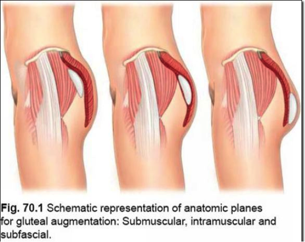 aumento gluteos implantes cirugia palstica