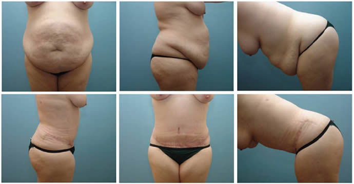 lipoescultura lipotransferencia liposucción cirugía plástica