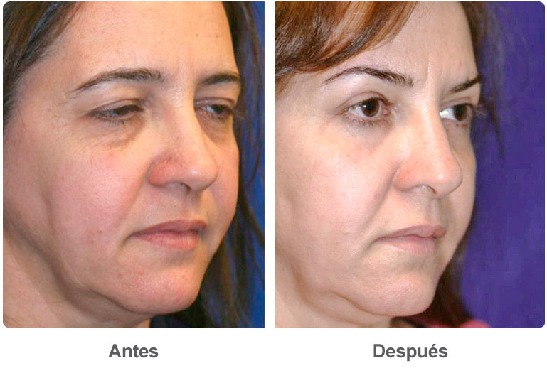 elevacion cejas cirugia plastica estetica mexico