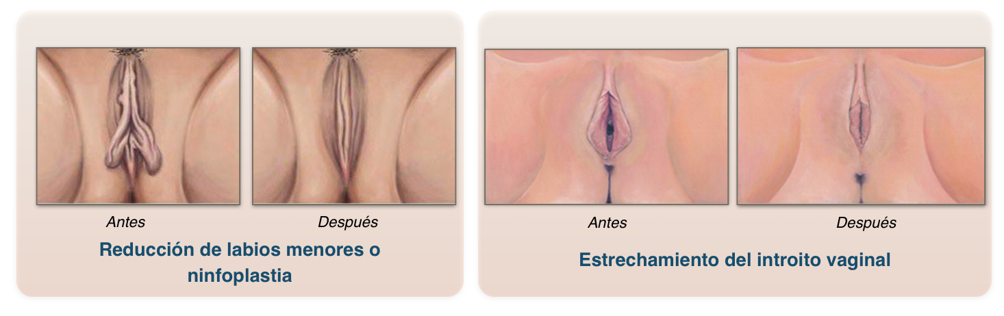 rejuvenecimiento vaginal virgen cirugia plastica