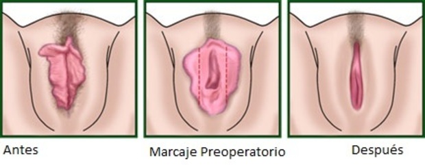 rejuvenecimineto vaginal reconstruccion virginidad