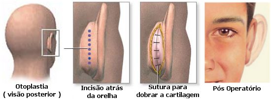 reducción orejas lobulo oreja cirugia plastica estetica