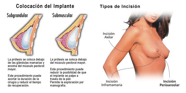 aumento de senos cirugía plastica