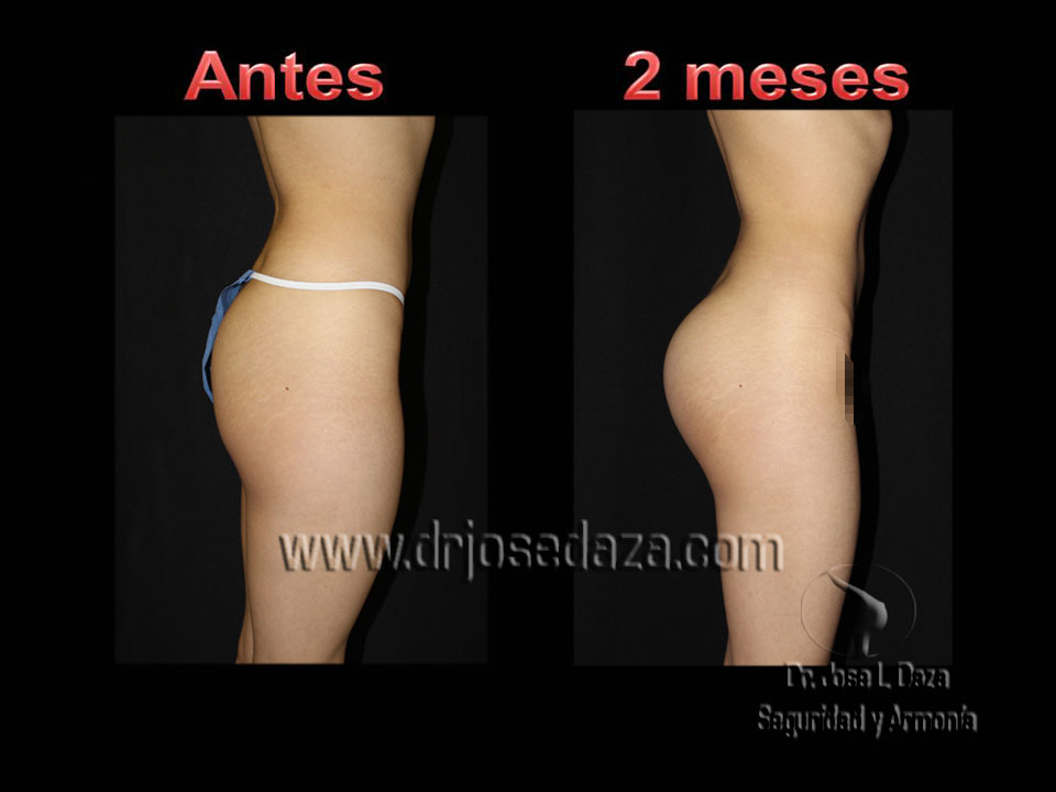 aumento gluteo pompas cirugia plastica