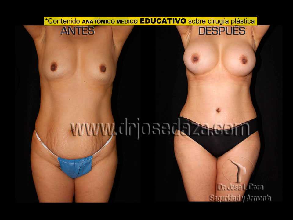 lipoabdominoplastia cirugia plastica mexico