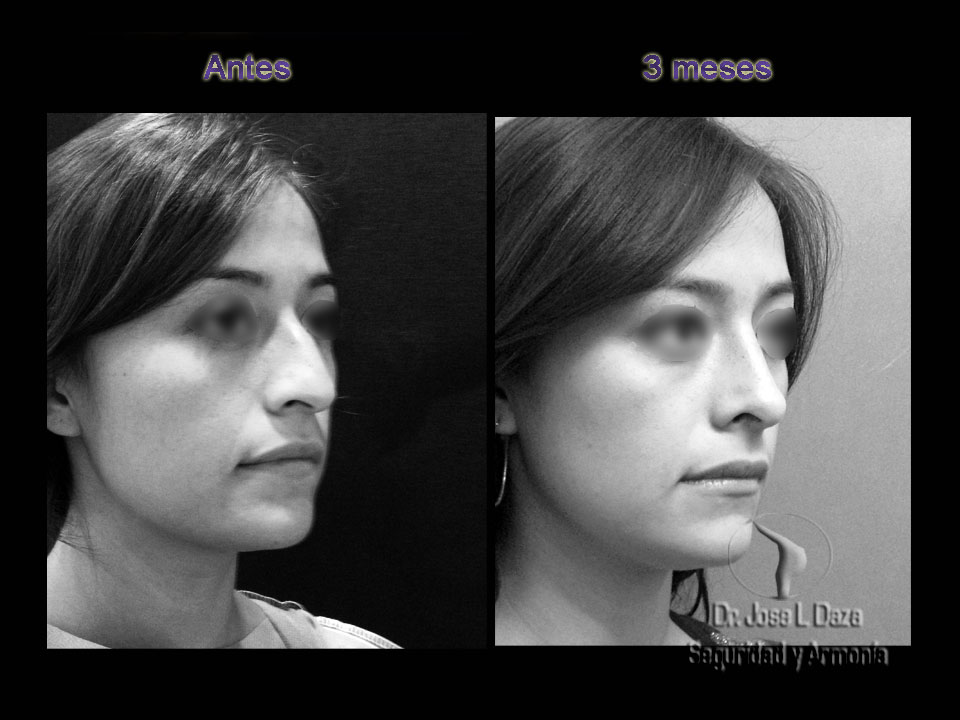 rinoplastia cirugía plástica